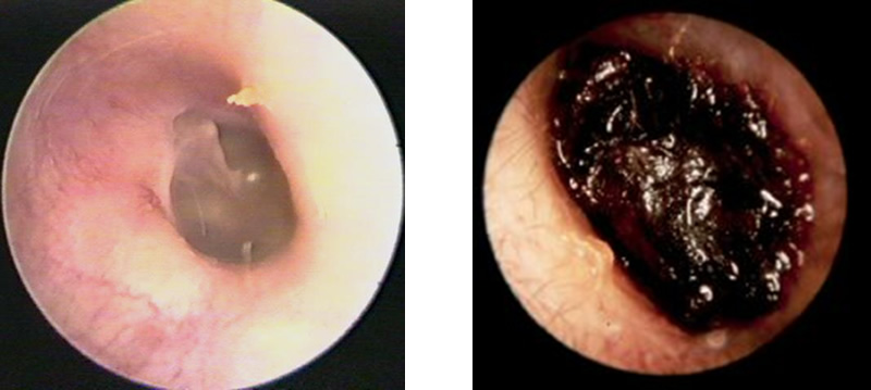 Earwax problems