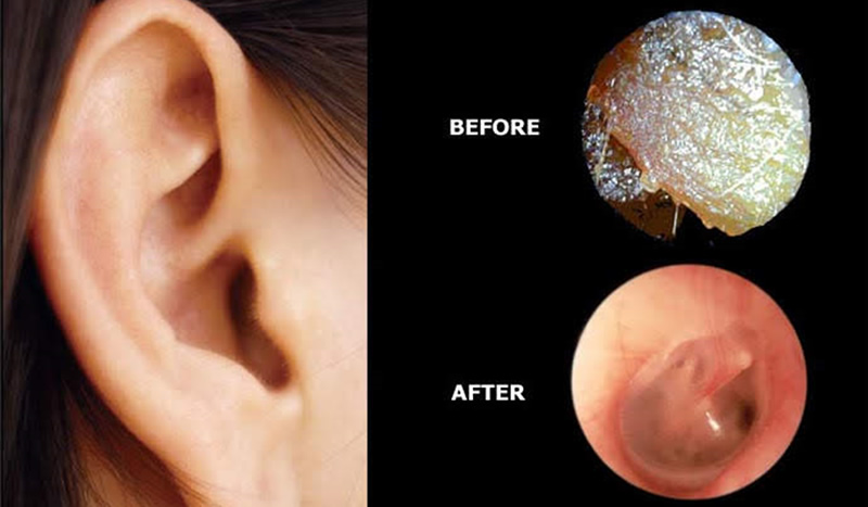 Whistling hearing aid
